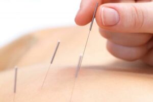 Dry needling