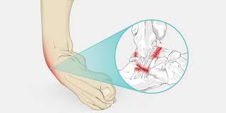 Chronic Ankle Instability