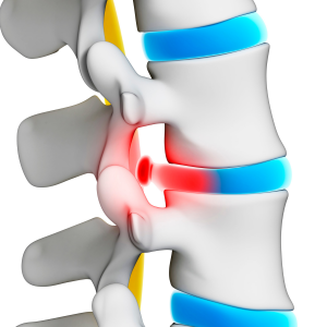 Injury to the disc is one of the most common causes leading to neck pain, back pain and sciatica (pain shooting down the leg). 