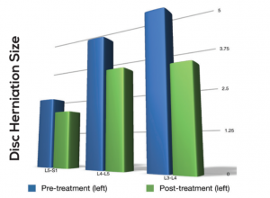 Research shows Spinal Decompression reduces disc herniation size up to 90% in a majority of patients while decreasing pain by 90%