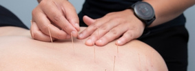 Dry Needling