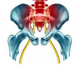 Sciatica